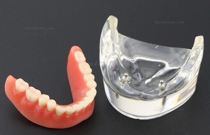 Dental Teeth Model Overdenture Inferior with 2 Implants Study Demo Model 6002 01